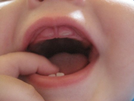 Послідовність прорізування зубів у дітей. Порядок і строки прорізування молочних зубів