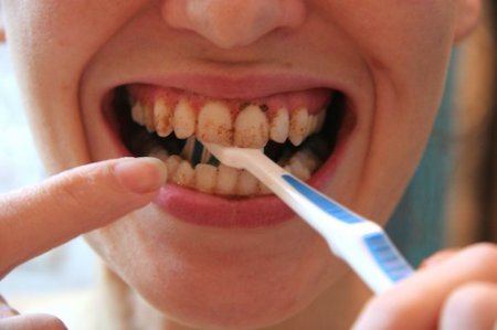 Зубний порошок або паста - що краще? Зубний порошок відбілюючий: відгуки стоматологів