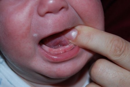 Коли ріжуться перші зубки: симптоми