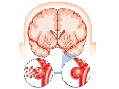 Невтішний діагноз: інсульт лівої сторони мозку