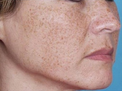 Пігментні плями на обличчі: причини появи і боротьба з ними