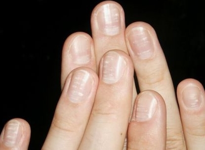 Що позначають білі цятки на нігтях