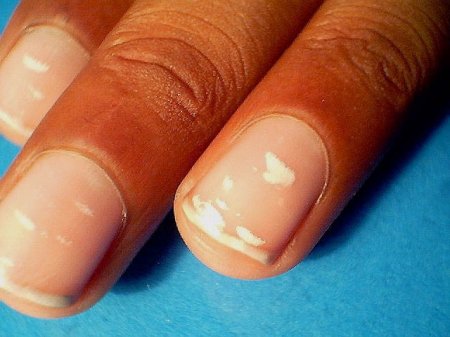 Що може означати біла пляма на нігті?
