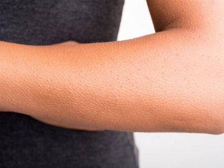 Як позбутися від гусячої шкіри на стегнах і руках?
