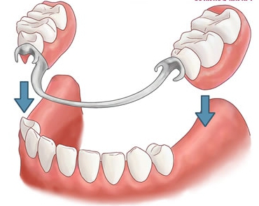 Покривні зубні протези (фото). Як кріпиться покривний зубний протез?