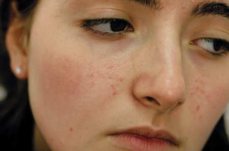 Вугрової висип на обличчі: причини і лікування