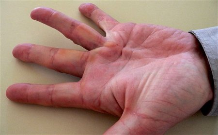 Німіє палець правої або лівої руки: причини