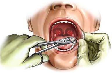 Чи можна полоскати рот після видалення зуба? Чим полоскати рот після видалення зуба?