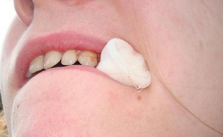 Чи можна полоскати рот після видалення зуба? Чим полоскати рот після видалення зуба?