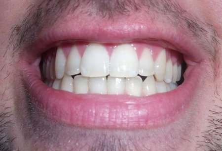 Синій зуб: причини. Що робити, якщо зуб посинів?
