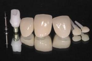 Цирконієві коронки для зубів: відгуки, фото