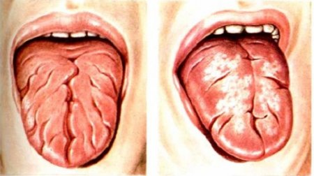 Географічний язик: причини виникнення, лікування