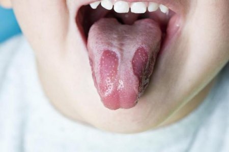 Географічний язик: причини виникнення, лікування