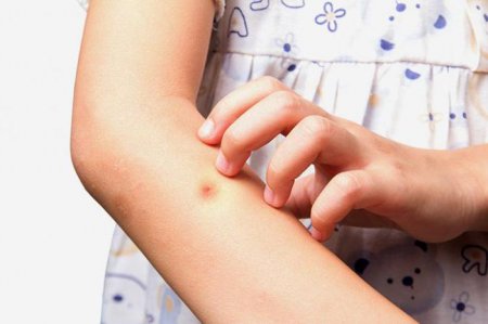 Укус комара у дитини: як усунути наслідки? Реакція на укус комара у дитини