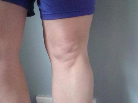 Як прибрати жир з коліна внизу? Як прибрати жир з колін, над колінами, з внутрішньої сторони колін швидко? Вправи