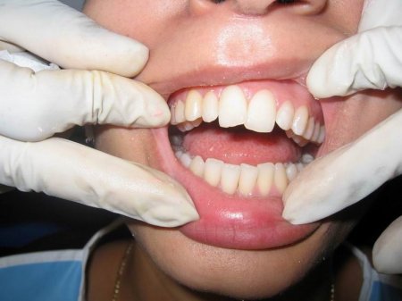 Як вирівняти зуби в домашніх умовах?