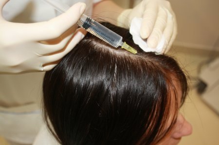 Мезотерапія для волосся: застосування, відгуки