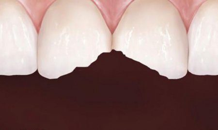 Зуб кришиться - що робити? Лікування зубів, поради стоматолога