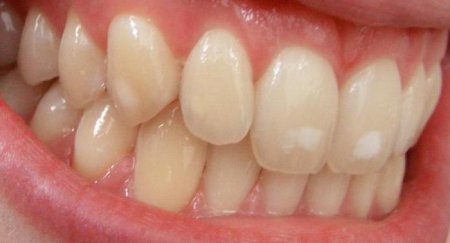 Флюороз зубів: причини, лікування, профілактика