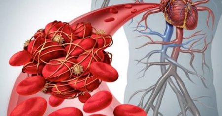 9 безпечних, натуральних розріджувачів крові для зменшення згустків крові (тромбоз) і ризику інсульту