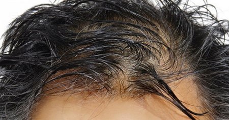Випадіння волосся: 2 простих методи для 100% усунення!