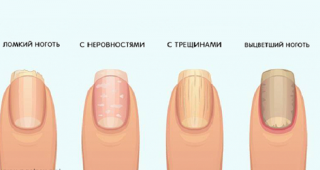 Попереджувальні ознаки ваших нігтів про ваше здоров'я