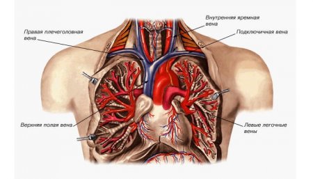 Синдром верхньої порожнистої вени